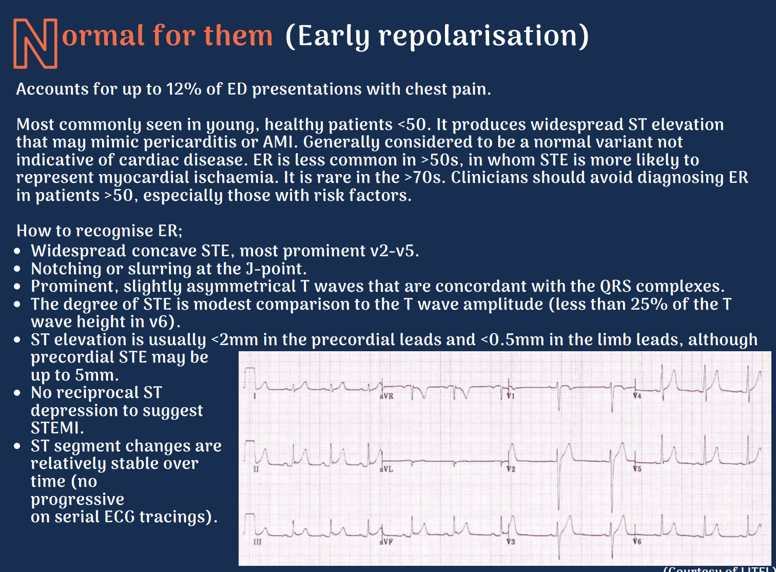 STEMI mimics; A mnemonic featured image